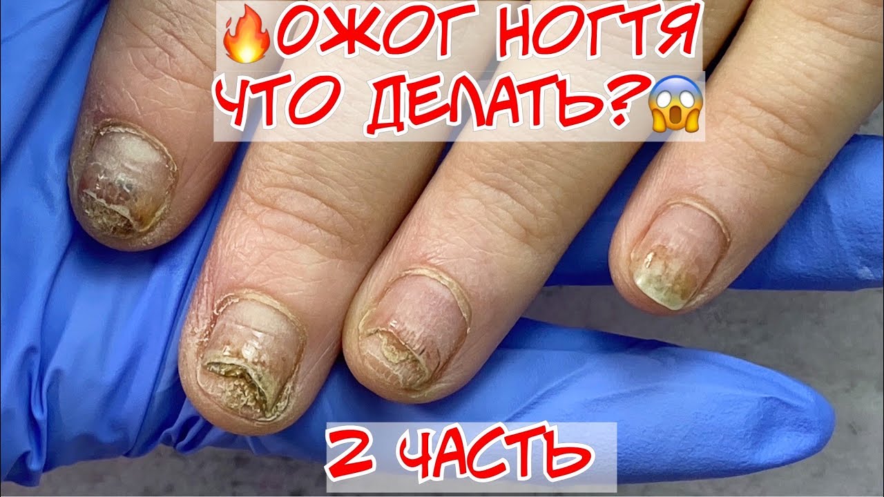 🔥 Что с ногтями? 😱😫 часть 2 🔥 Онихолизис ногтей 