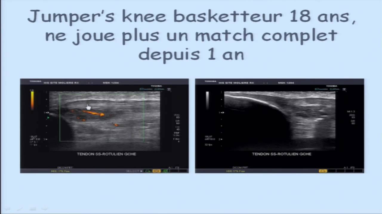 Intérêt de l'échographie dans les injections de PRP par le Pr Philippe Peetrons