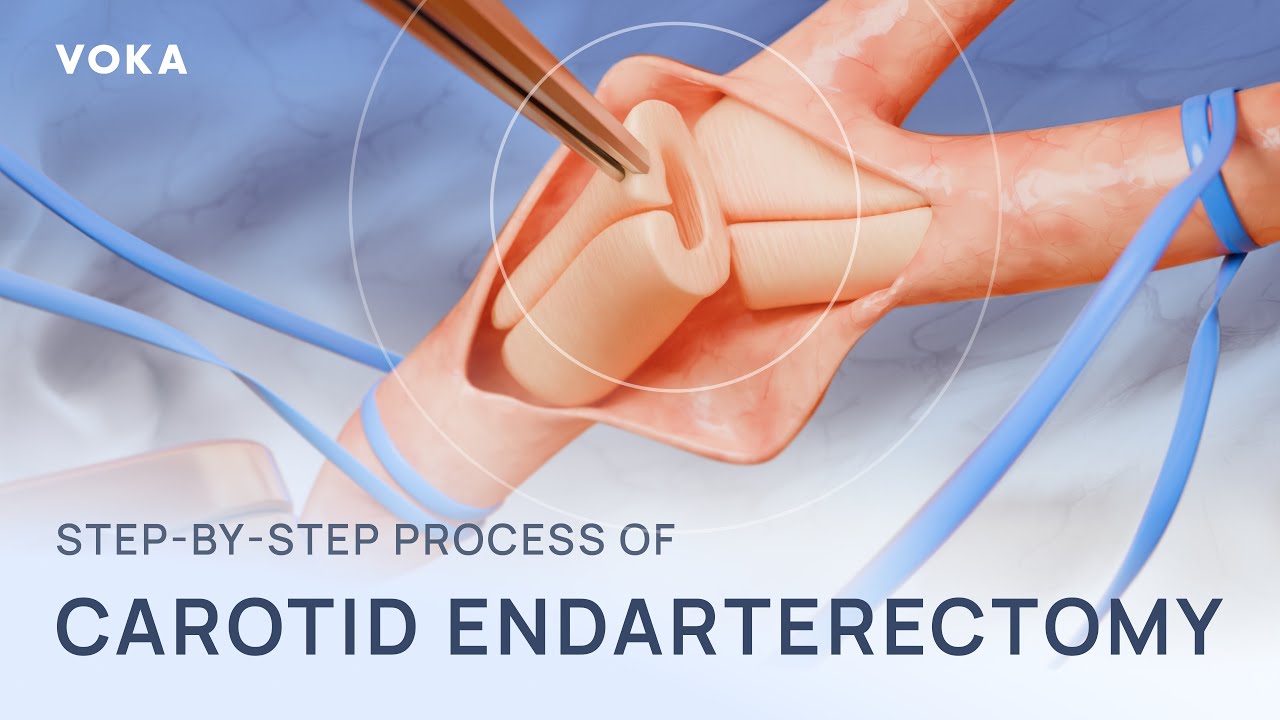 Carotid endarterectomy medical animation: from plaque removal to restored blood flow