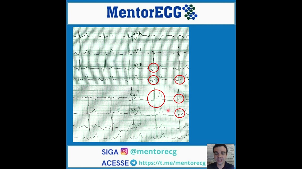 Repolarização precoce