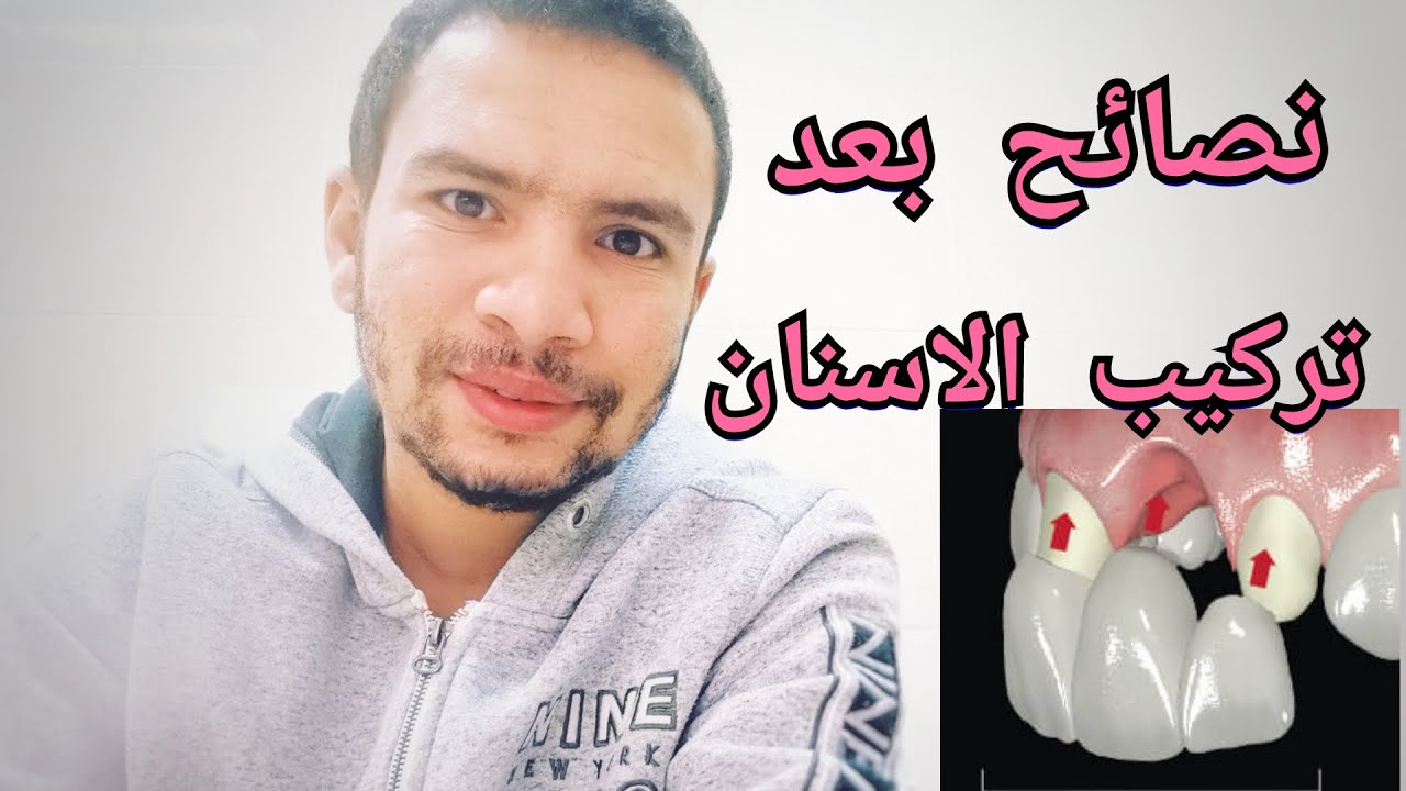 تعليمات بعد تركيب الاسنان الثابته لا يقولها لك طبيب الاسنان
