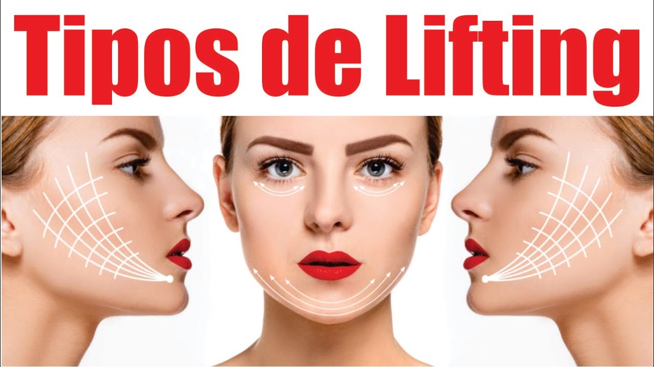REJUVENECIMIENTO de ROSTRO 👩‍🦳➡👩‍🦰 TIPOS de LIFTING FACIAL  🩺 Dr ALBERTO CALVO QUIROZ