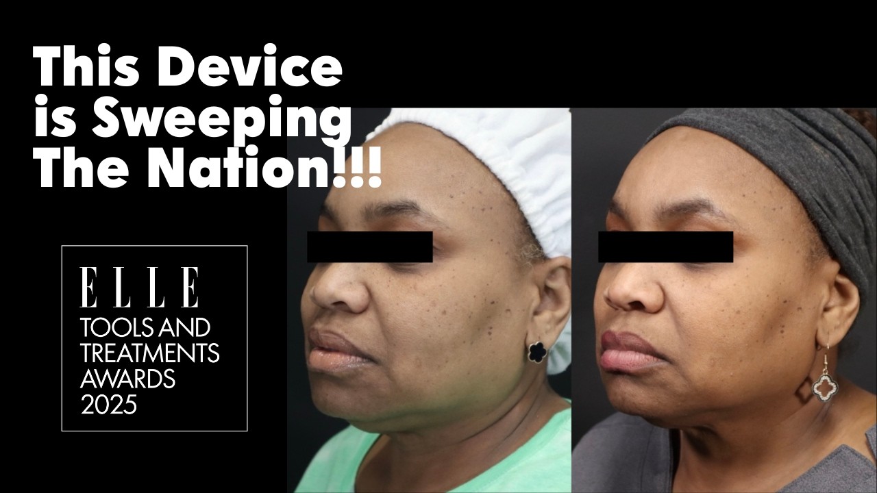 Lift, Tighten & Volumize Without Surgery | Everesse RF Before & After