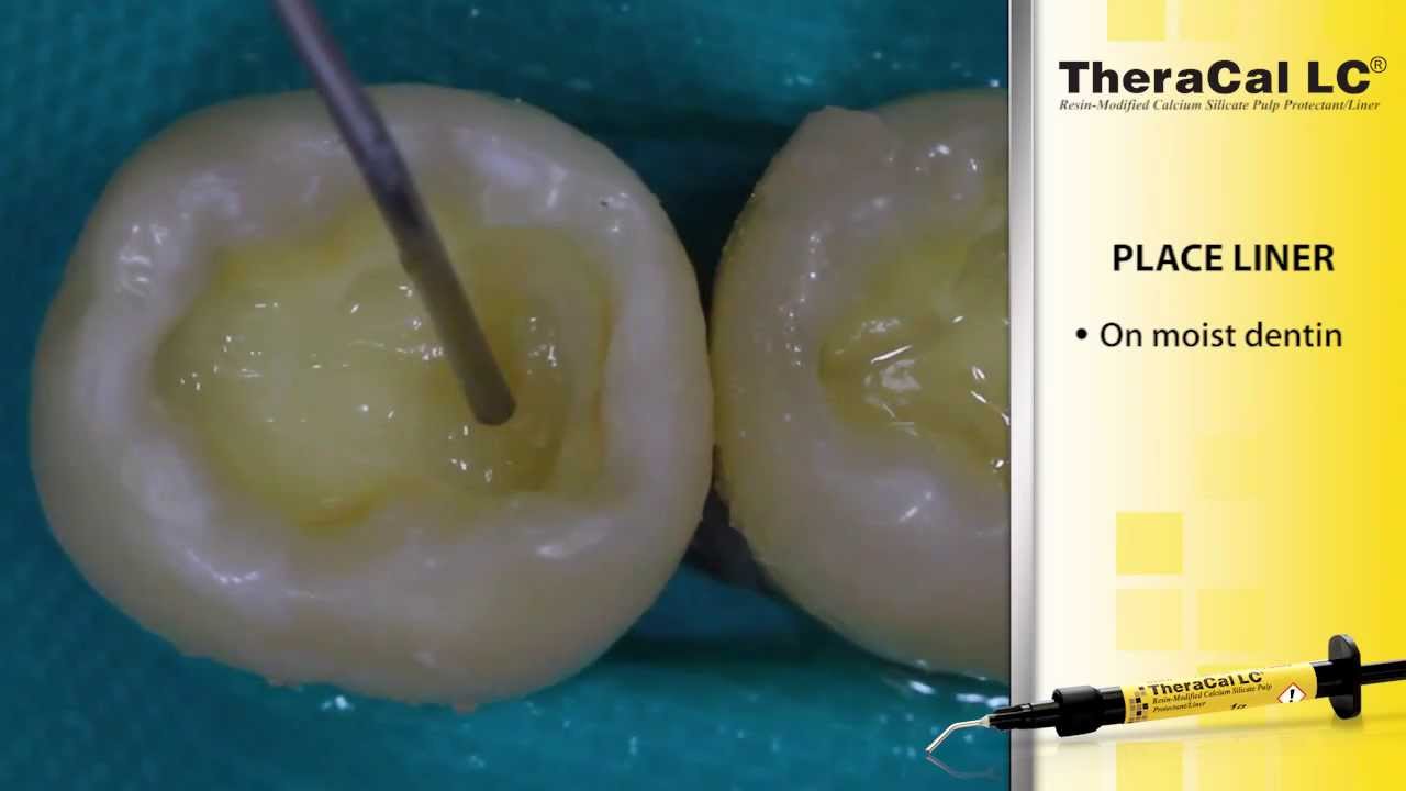 Direct Composite Placement Using TheraCal LC and All-Bond Universal