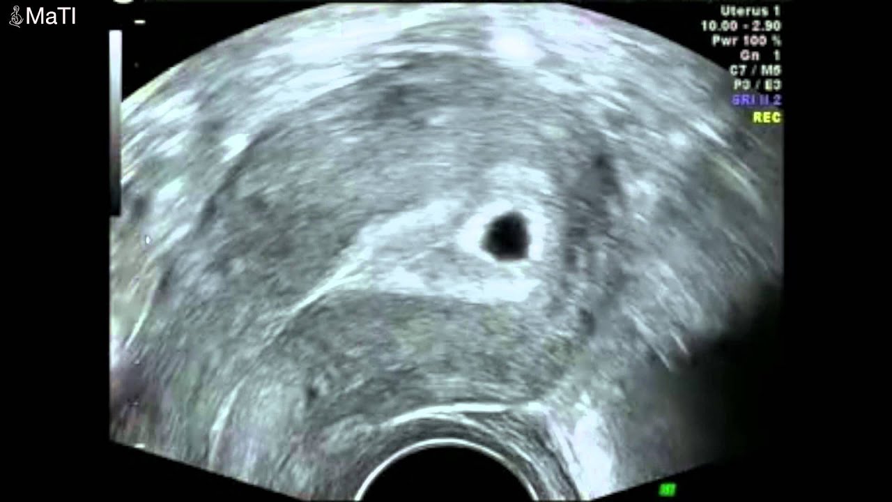 Early pregnancy scan - ultrasound 5 weeks gestation