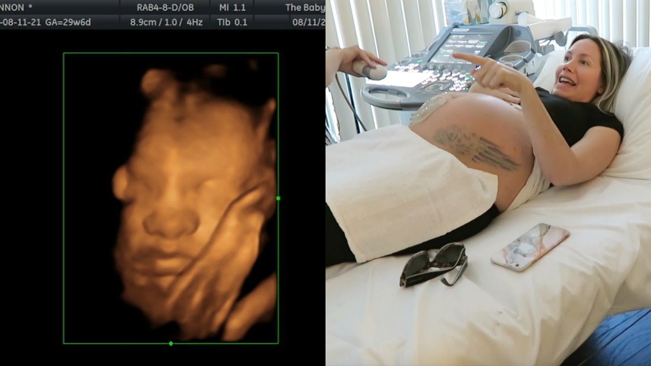 3D ULTRASOUND OF OUR MIRACLE BABY