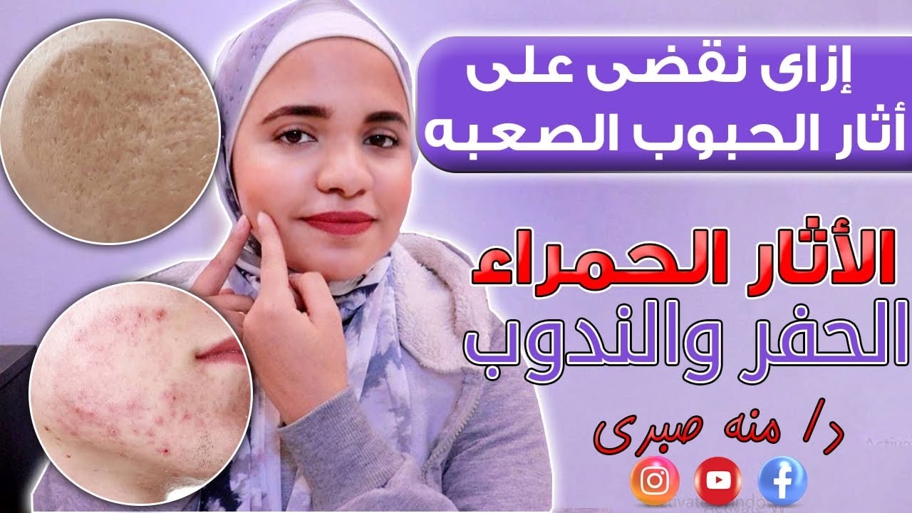 التخلص من اثار حب الشباب الحمراء و الحفر و الندوب