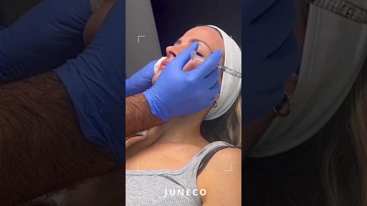 Riempimento zigomi con filler: come funziona?