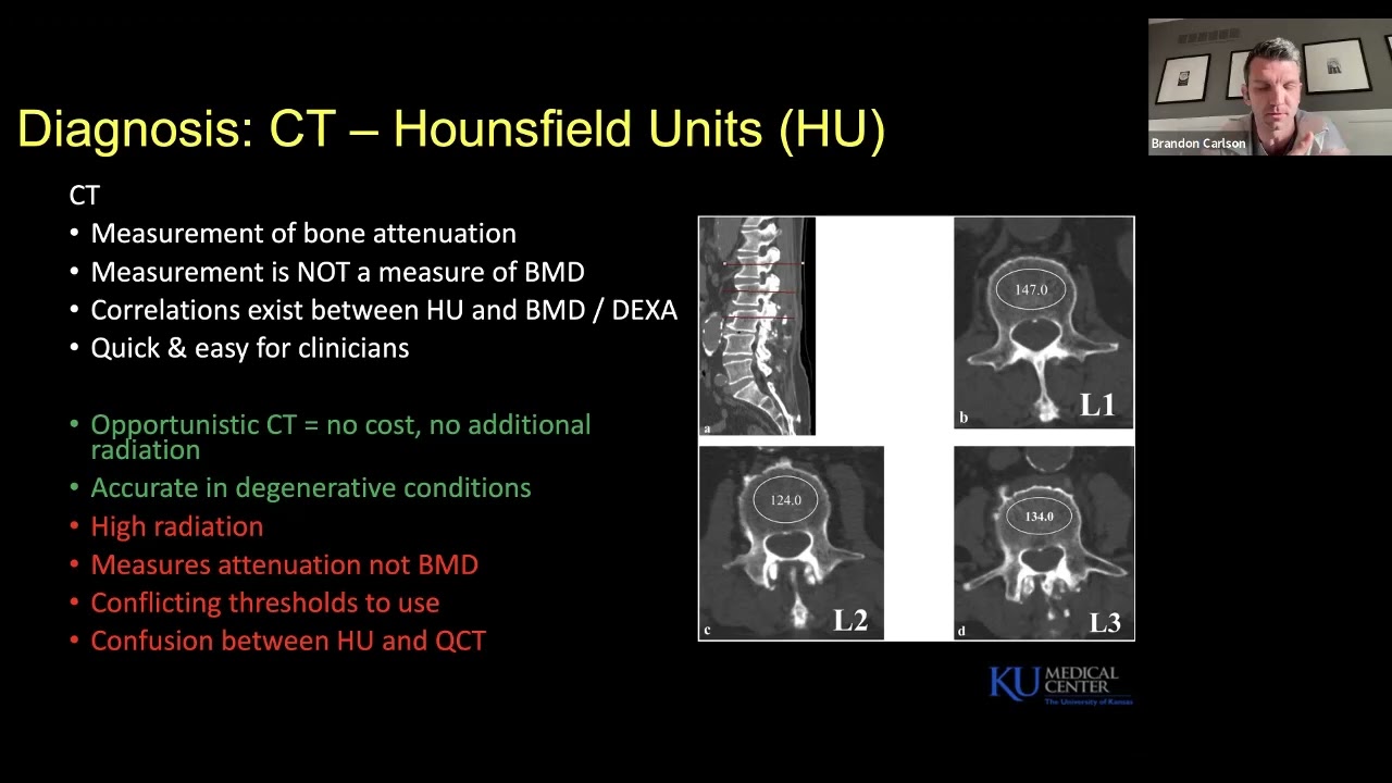 Metabolic Bone Health: Diagnosis, Management : Brandon B. Carlson, MD, MPH