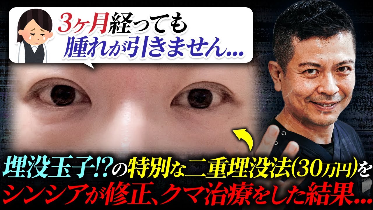 【二重埋没法】術後のダウンタイムが3ヶ月続いた患者様をシンシアで修正治療しました。失敗や後悔しない正しい考え方をお教えします。