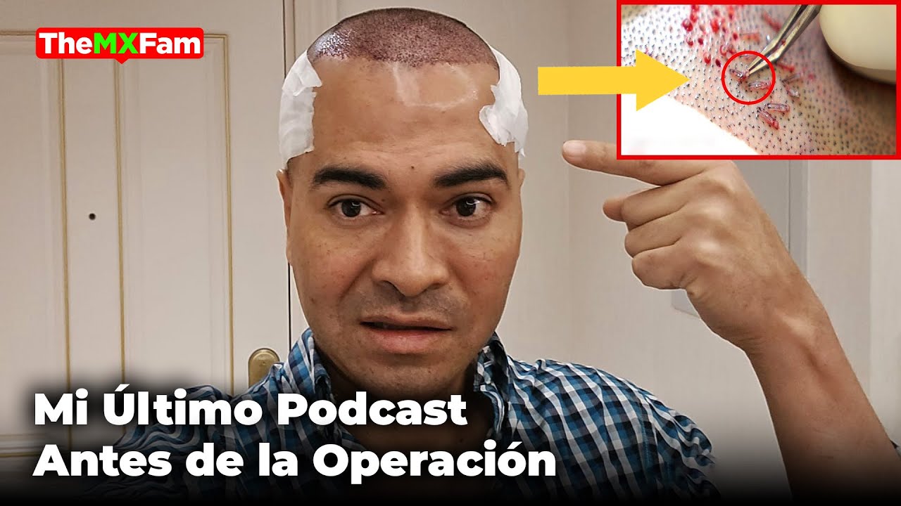 El Último Podcast Antes de Mi Operación de Transplante de Cabello   ⁨@DrSerkanAyginClinic⁩