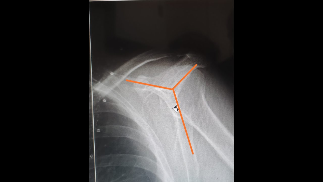 Omuz Y Grafisi, omuz AP, Shoulder Y Graphs