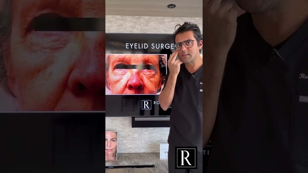 Do you have tired-looking eyes? #plasticsurgerybeforeandafter #shortsvideo