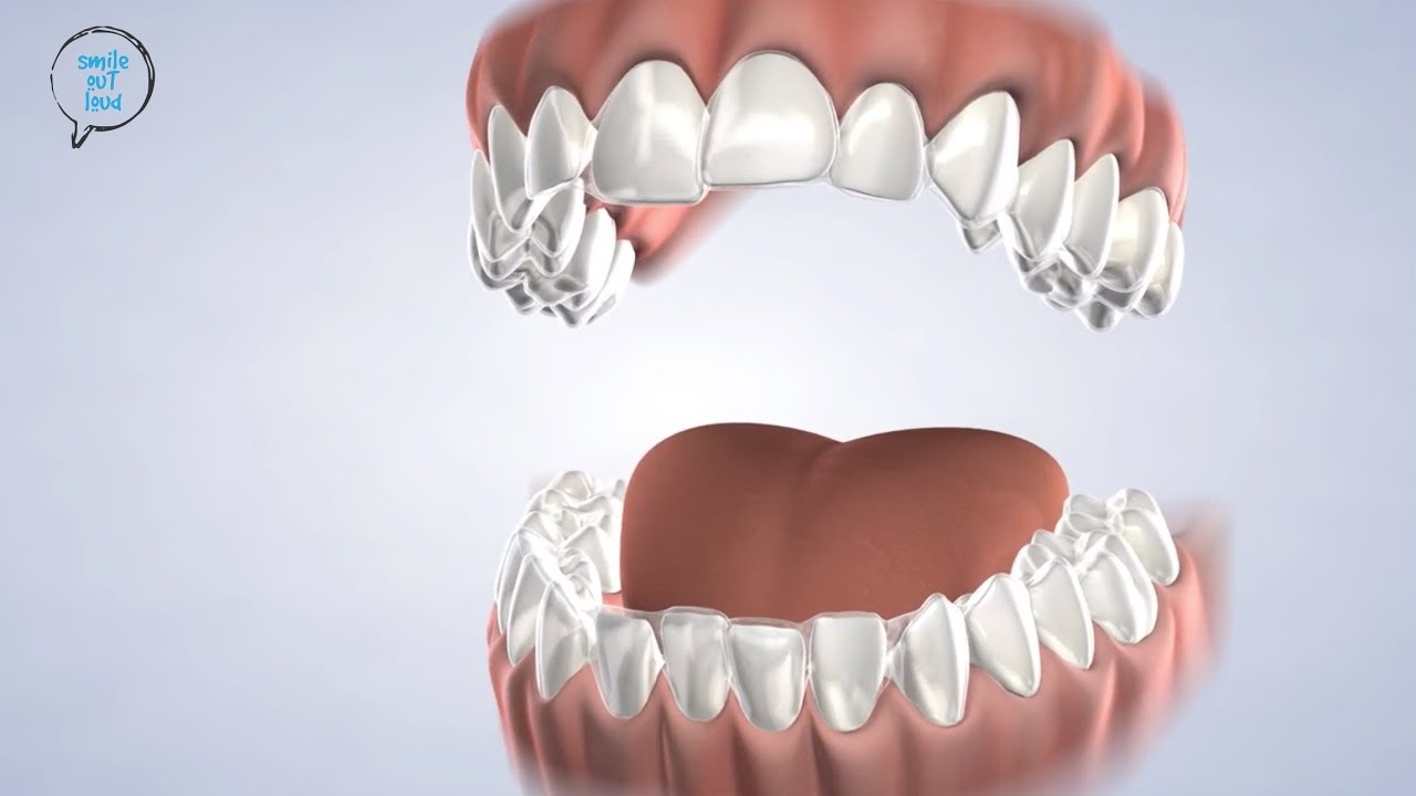 Invisalign® in Amarillo TX | Harwell & Cook Orthodontics