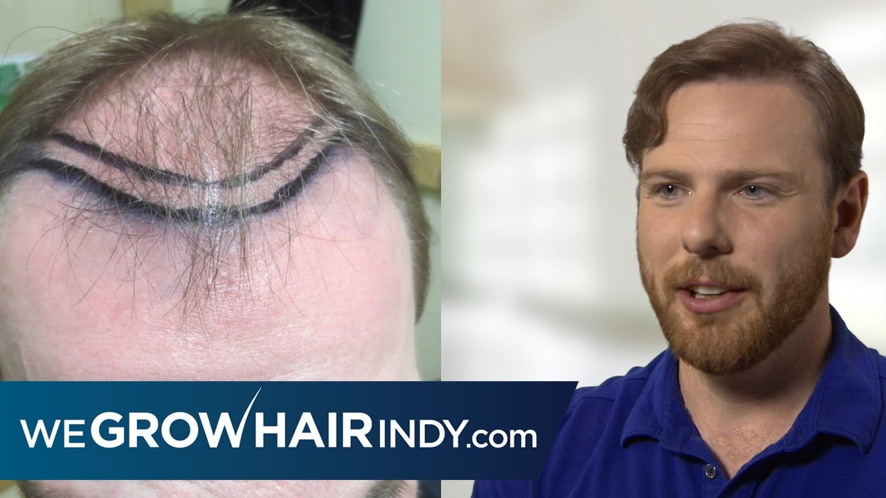 Multi-Unit Hair Grafting™ Hair Transplant | PAI Medical Group of Indiana - Sean