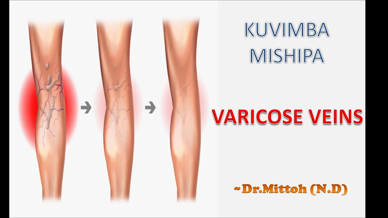 SABABU ZA KUVIMBA MISHIPA YA MIGUUNI (VARICOSE VEINS / SPIDER VEINS) | Mittoh_Isaac (N.D)