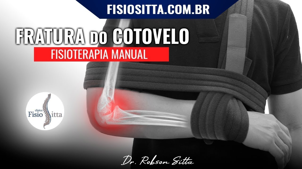 FISIOTERAPIA MANUAL FRATURA COTOVELO CABEÇA do RÁDIO + OLÉCRANO + CORONÓIDE Clínica Dr. Robson Sitta