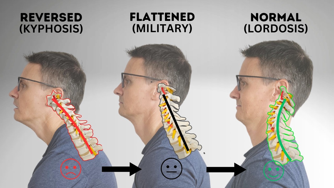 How to Fix Cervical Kyphosis, Flat Neck, or Military Neck | Neck Posture Fix