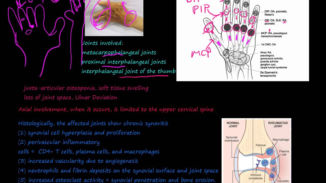 93P What is Rheumatoid Arthritis, RA, morphology, prevalence, pannus, Rheumatoid nodules