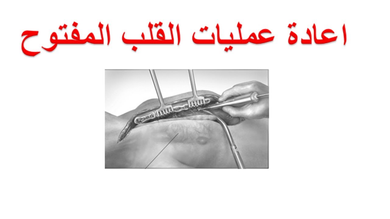 هل يوجد مخاطر في اعادة عمليات القلب المفتوح ؟ من يحتاج و ما هي مضاعفات اعادة جراحة القلب المفتوح ؟