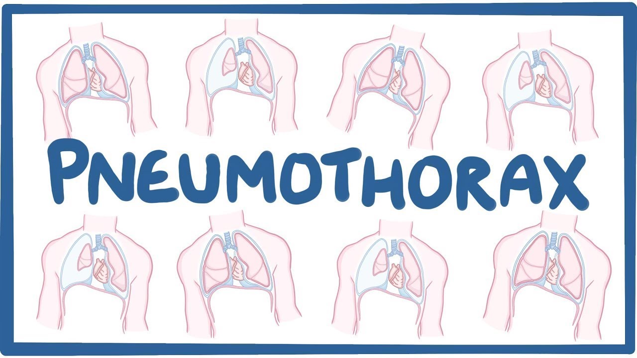 Pneumothorax - causes, symptoms, diagnosis, treatment, pathology