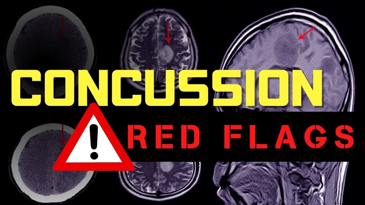 Red Flags for a Concussion
