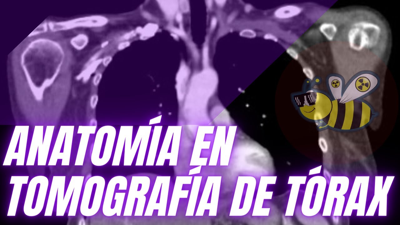 ANATOMÍA EN TOMOGRAFÍA DE TÓRAX
