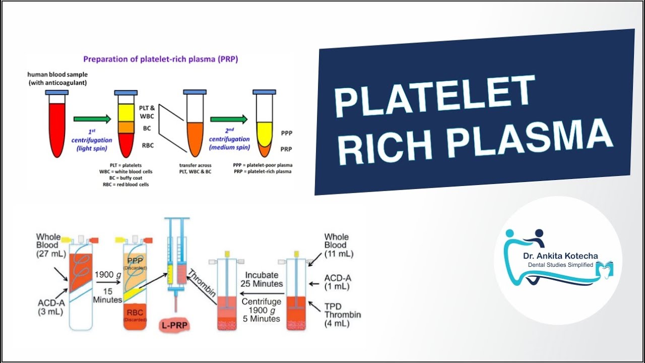 PLATELET RICH PLASMA (PRP) IN PERIODONTICS/ BIOLOGIC PROPERTIES/ PREPARATION/APPLICATIONS/ DRAWBACKS