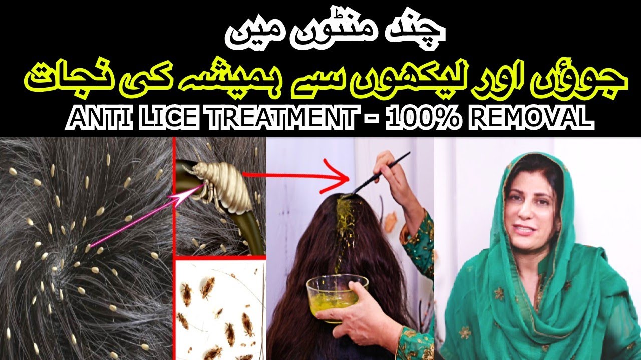 100% REMOVE LICE (JOUN) PERMANENTLY | VERY EASY LICE TREATMENT IN URDU /  HINDI | GUARANTEED RESULT