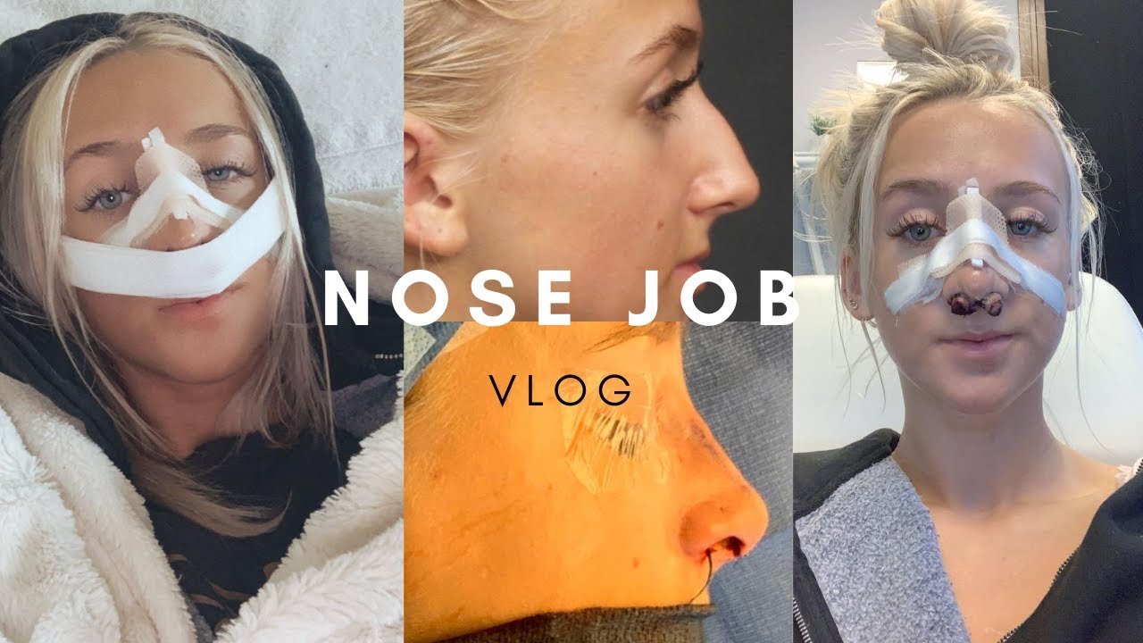 NOSE JOB VLOG | experience, recovery, before and after!!
