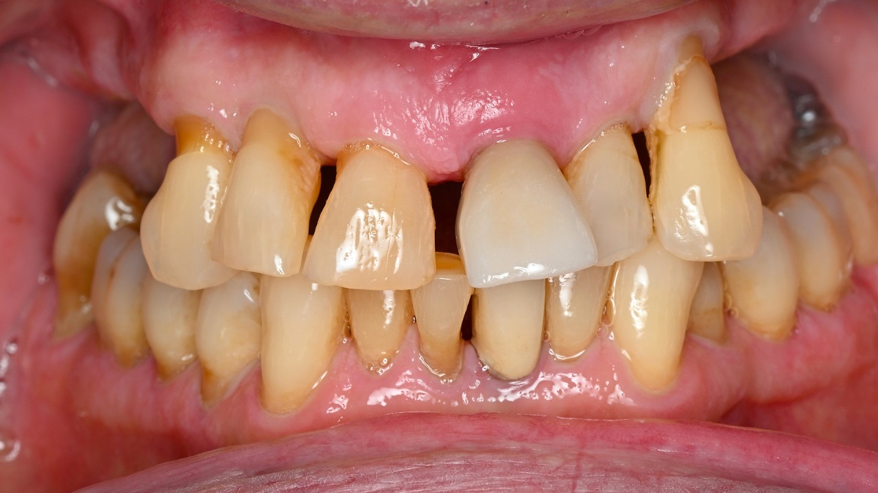 Ему было слишком стыдно улыбаться... ЭТО изменило всё | Зубные имплантаты All-on-X