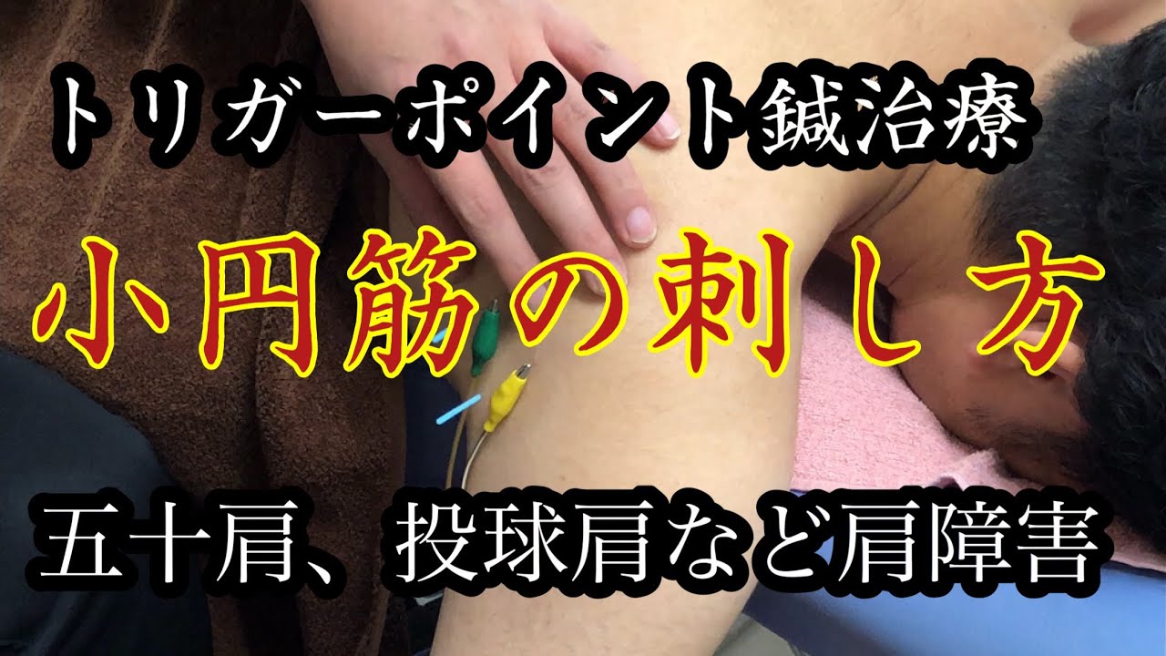トリガーポイント鍼治療 小円筋編 五十肩、投球肩など肩障害trigger point acupuncture　Small circular muscle