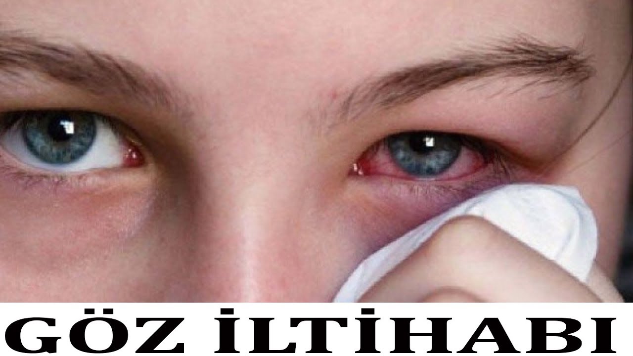 Göz iltihabı BAXIN nələrə səbəb olur! - Bəs necə müalicə edək?