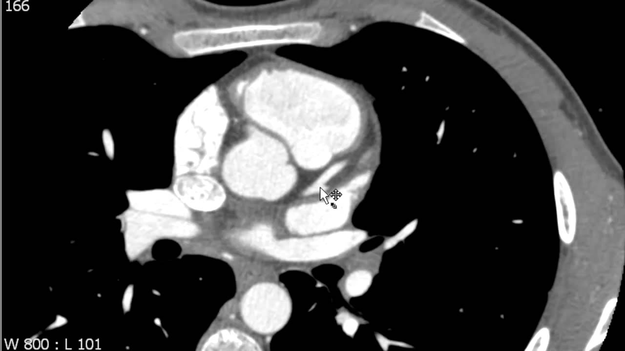 Ramus Intermediate Branch on Axial CT