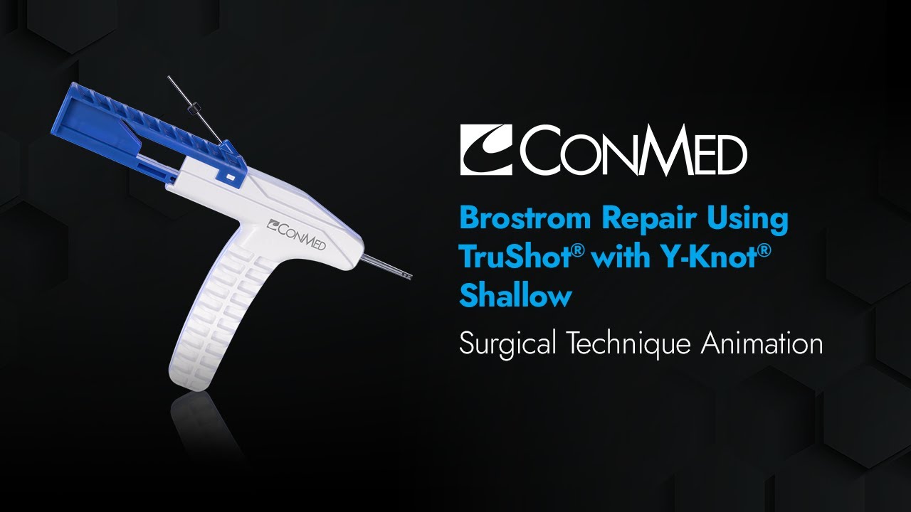Ремонт Брострома с помощью TruShot® с Y-Knot® Shallow — анимация CONMED