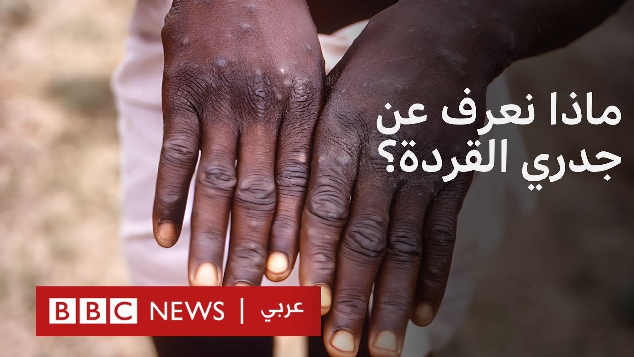 ما هو جدري القردة؟ ما الأعراض؟ وما مدى خطورته؟