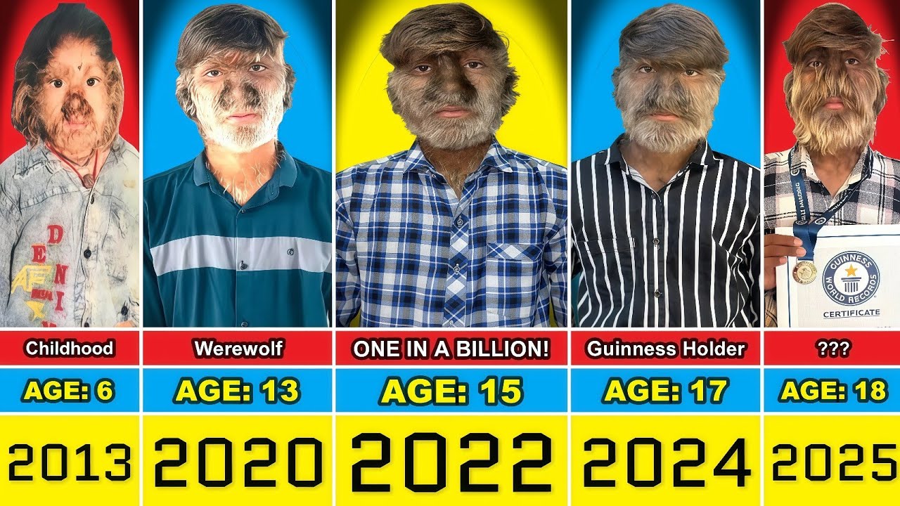 World's Hairiest Man Transformation From 0 to 18 Year Old