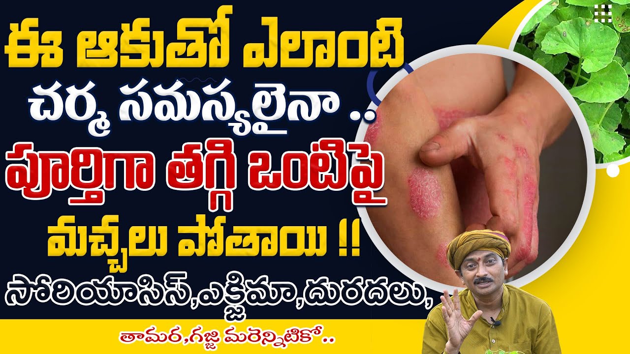 ఈ ఆకుతో ఎలాంటి చర్మ సమస్యలైనా పూర్తిగా తగ్గి ఒంటిపై మచ్చలు పోతాయి | Dr.Ravivarma | AYUR MANTRA