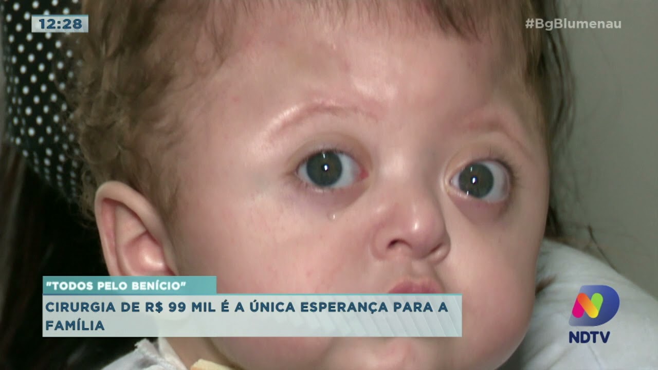 Família de Blumenau faz vaquinha para pagar cirurgia de bebê com síndrome de Apert