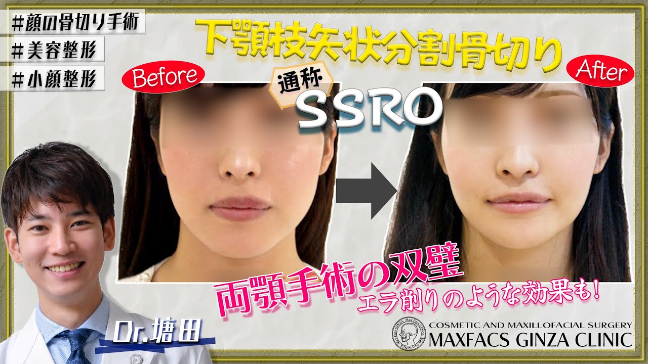 SSRO（下顎枝矢状分割術）について　マックスファクス銀座クリニック