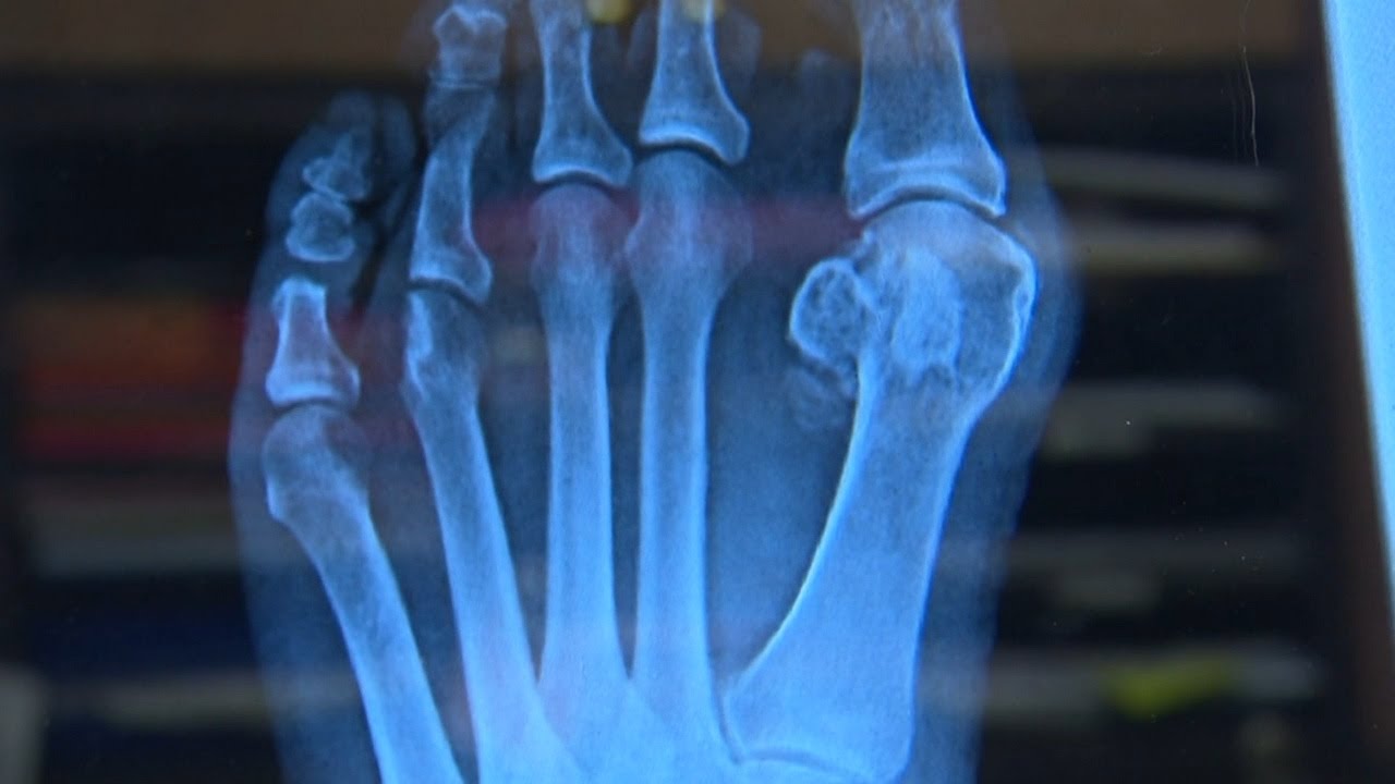 Doctors warning of the health complications caused by high heels