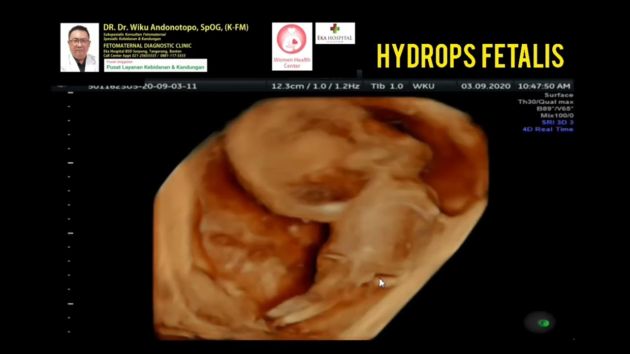 Hydrops Fetalis