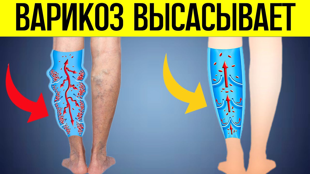 Варикоз очень легко лечится! Дома у каждого есть 