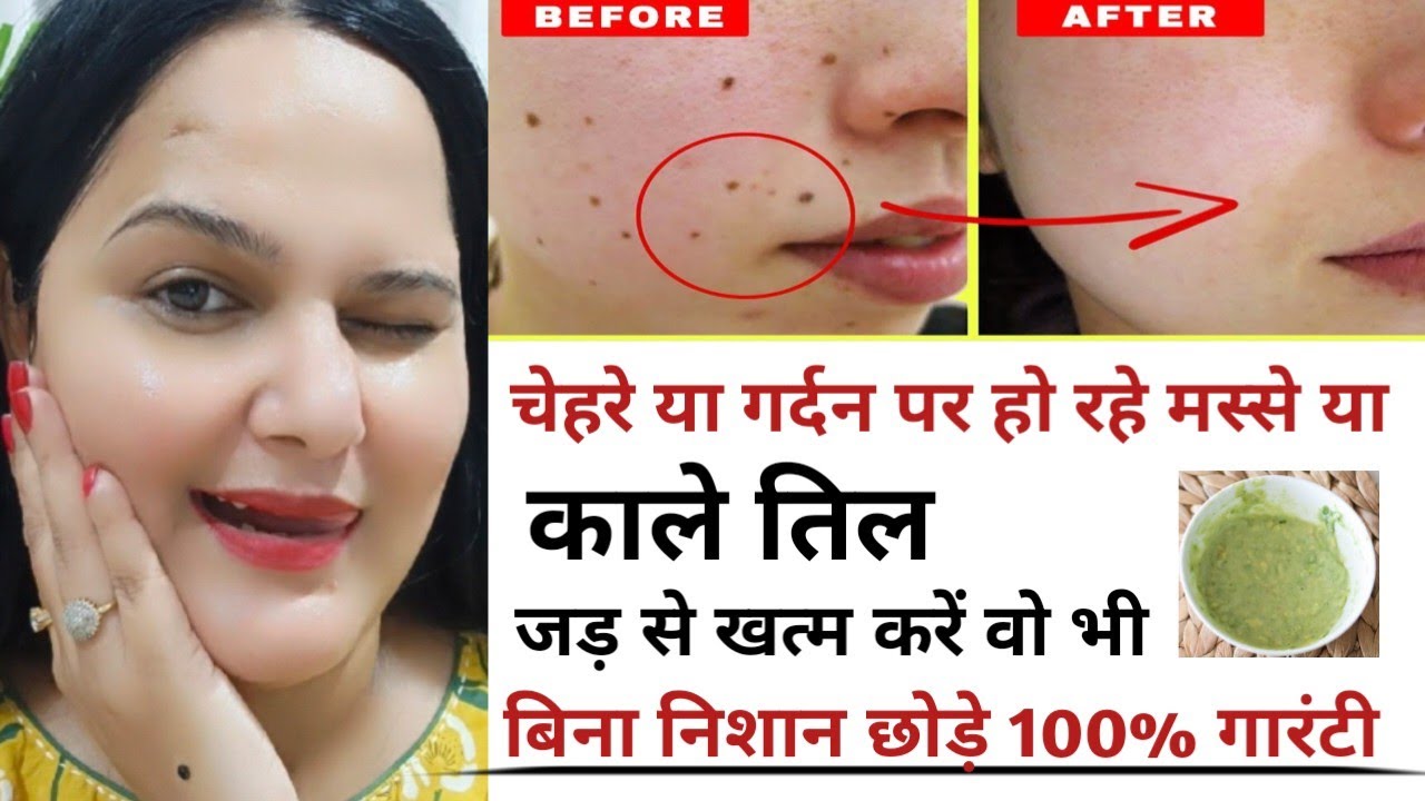 काले तिल और मस्से को जड से खत्म करने का सबसे तेज और अच्छा घरेलू उपाय-Remove Skin Tag Naturally#moles