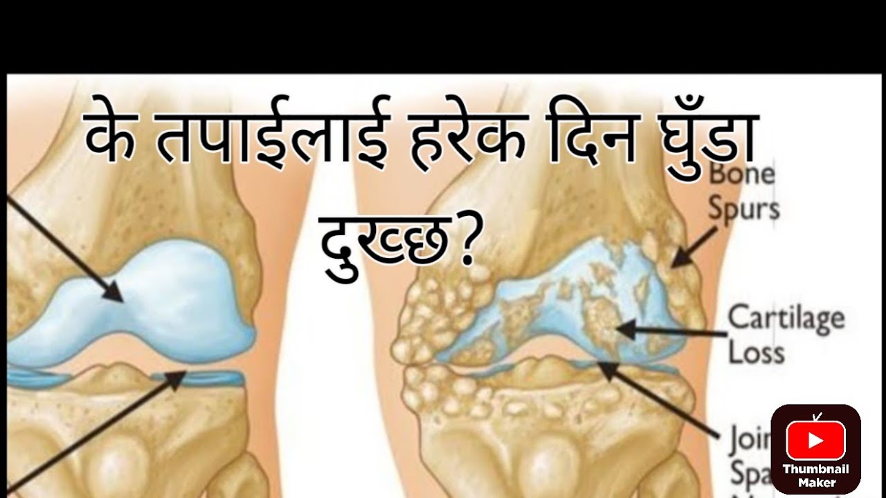 यदि तपाईलाई घुँडाको जोर्नीको ओस्टियोआर्थराइटिसको कारणले घुँडा दुख्ने समस्या छ?