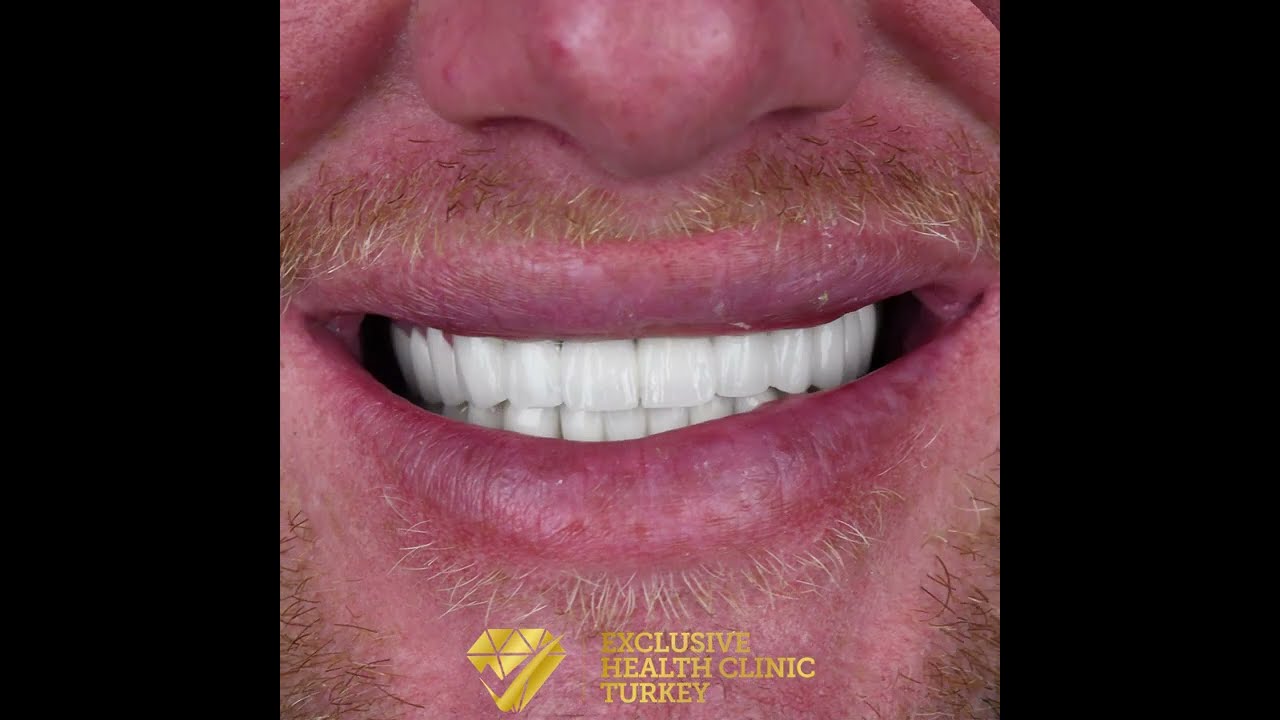 Exclusive Health Clinic Turkey I Dental Treatment in Turkey