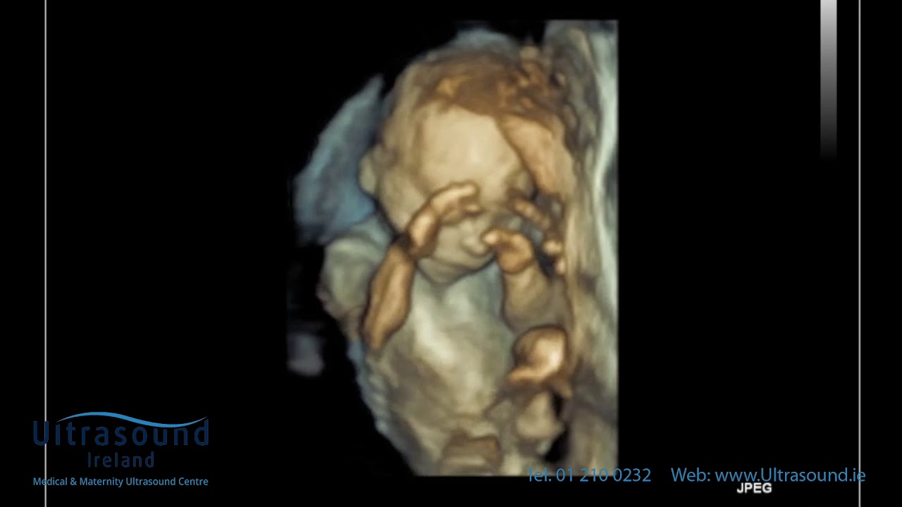 Scan of the Week: 22 Week Well Baby Scan