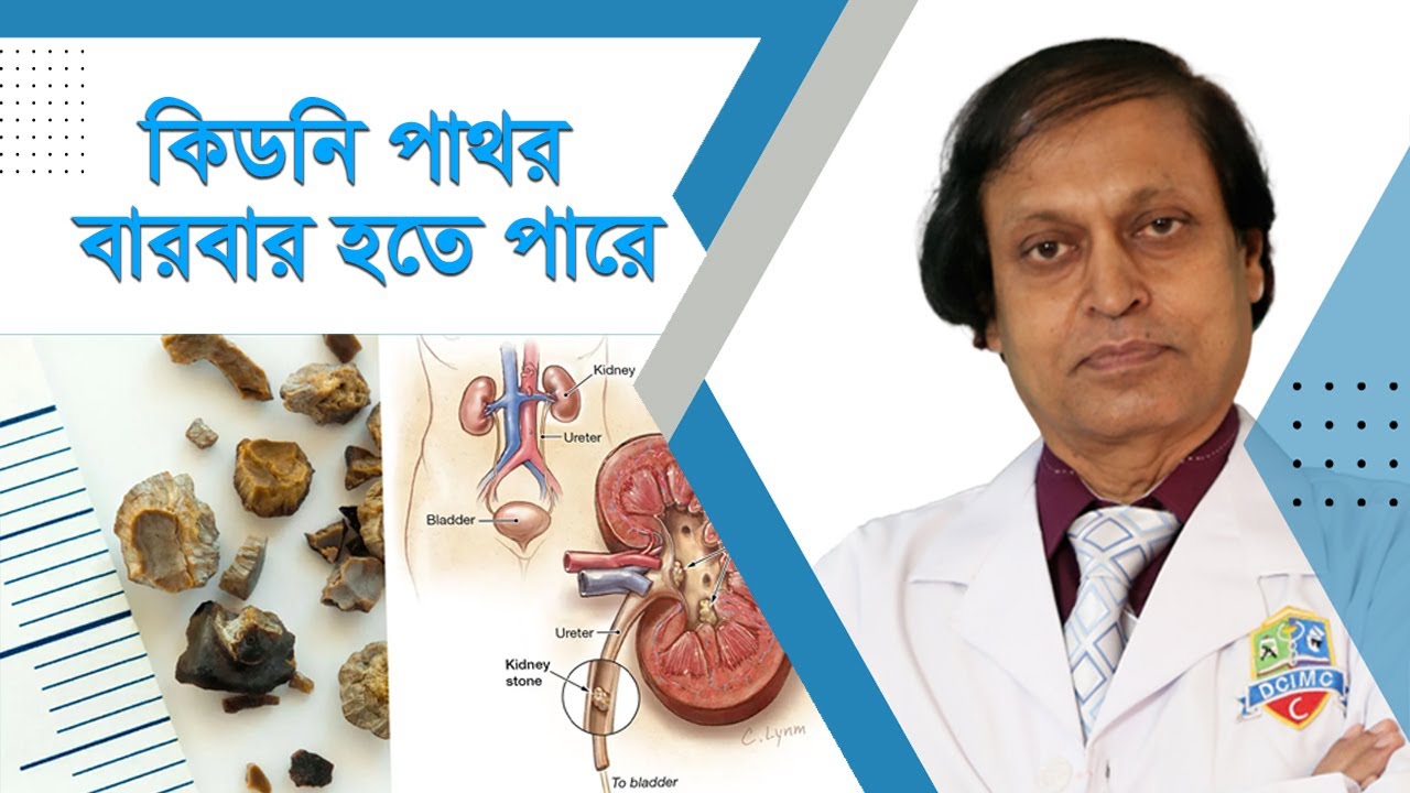 কিডনি পাথর বারবার হতে পারে। হাসপাতাল