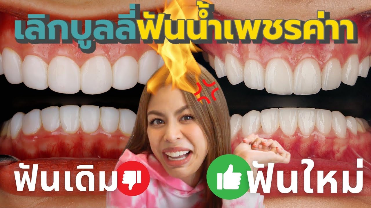 ปิดตำนานฟันแป้นเปียโน! น้ำเพชร มิสแกรนด์โดนบูลลี่ฟันหนักมาก! หลงไปทำวีเนียร์เถื่อน 3 เดือนมีกลิ่นปาก