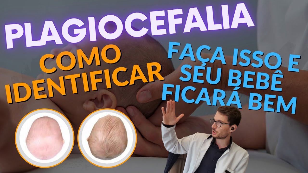 Cabecinha achatada Conheça os riscos da Plagiocefalia e descubra como evitar e como tratar